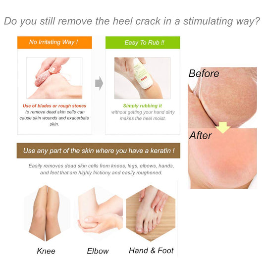 Purederm - Moisturizing Heel Crack Remover (Original)